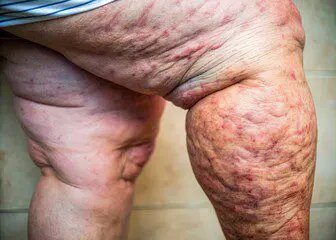 Comment l'ostéopathe peut soulager efficacement les œdèmes et les jambes lourdes ?